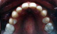 Dr Andor prepared teeth bottom