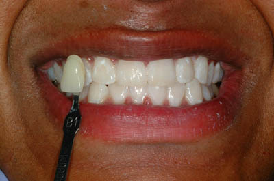 Jaikara after teeth whitening