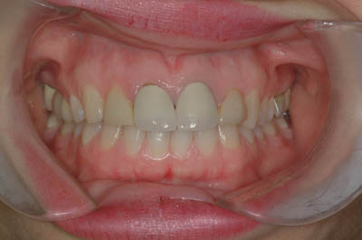 Kim's teeth before